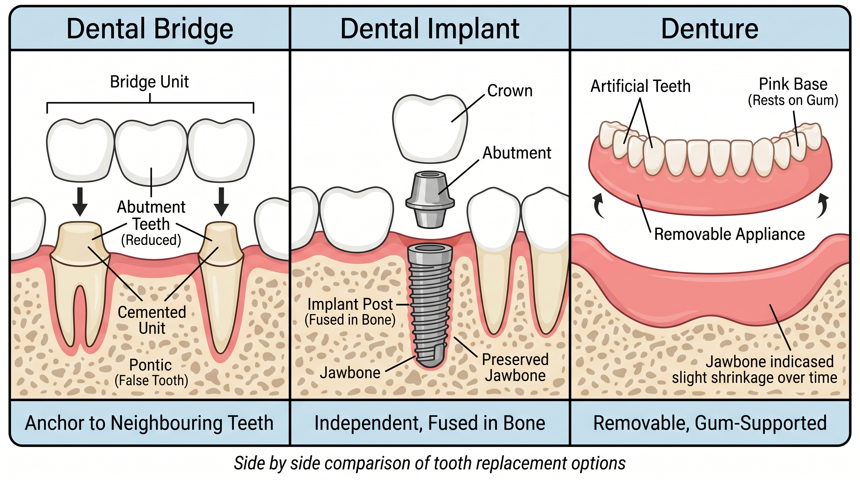 Diagram comparing how a dental bridge, implant, and denture replace missing teeth